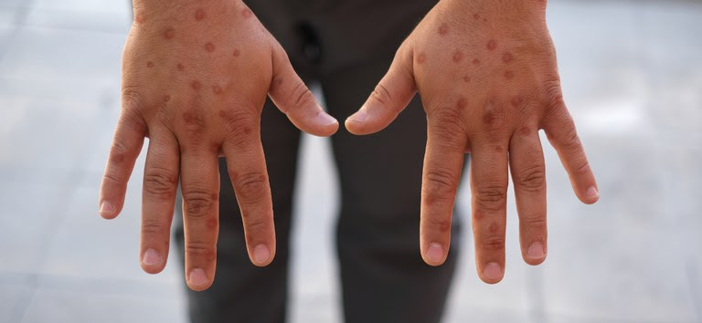  Mpox: Ministério da Saúde reforça vigilância para identificar nova variante