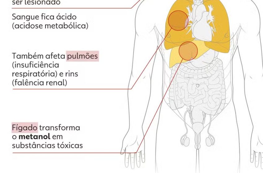  Intoxicação por metanol atinge 58 no brasil, investigações continuam